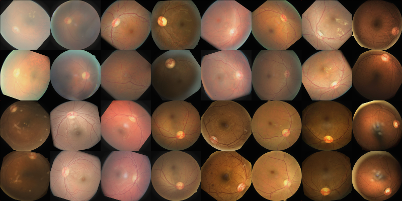 An older batch of augmented 512x512 samples as input to a network. The augmenting process went through some subtle changes since then. You can also see that the images are paired by patient but with independent augmentations (more about that later).